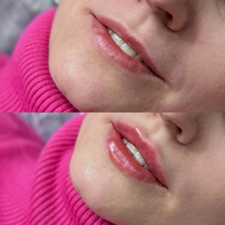 Lineárna retrográdna (klasická) technika zväčšenia pier