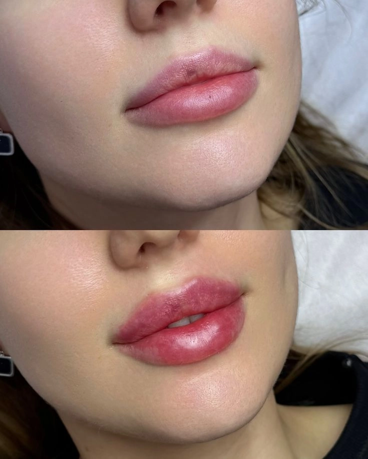 Technika zväčšenia pier mikroblus