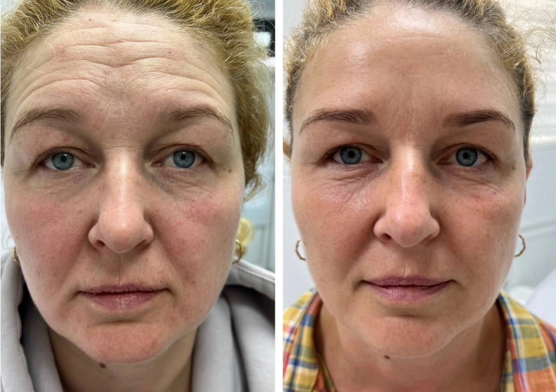 Kurz RF liftingu (Morpheus 8) + aplikácia botulotoxínu do hornej tretiny tváre