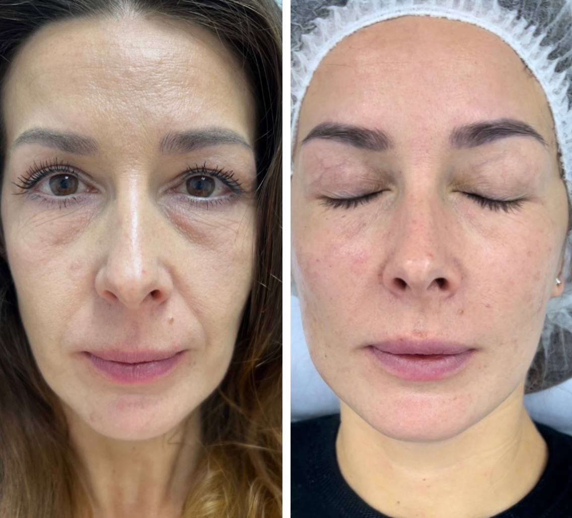 Výsledok po kurze RF liftingu (Morpheus 8)