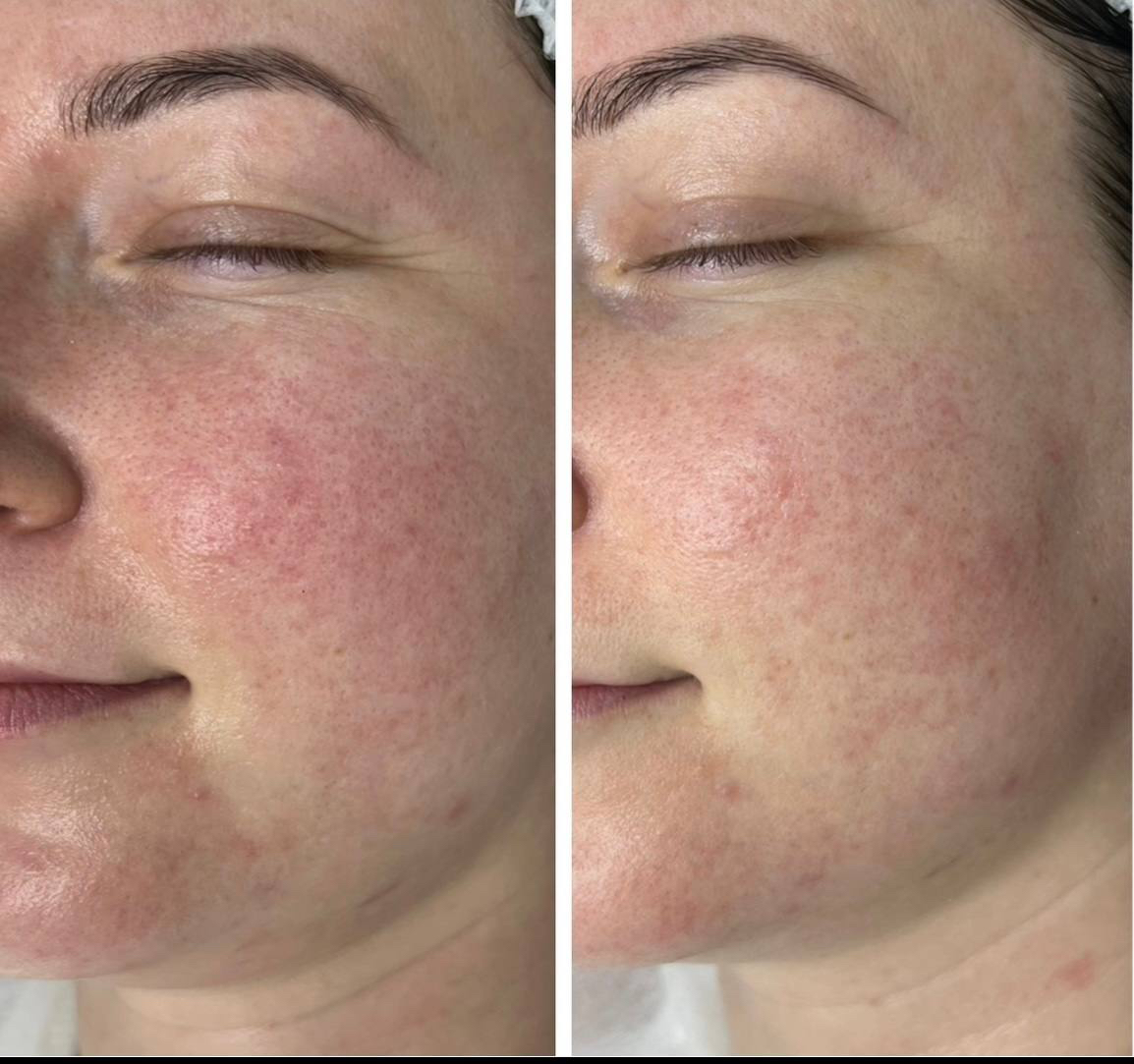 Výsledok liečby rosacey na oddelení kozmetológie Doktorpro