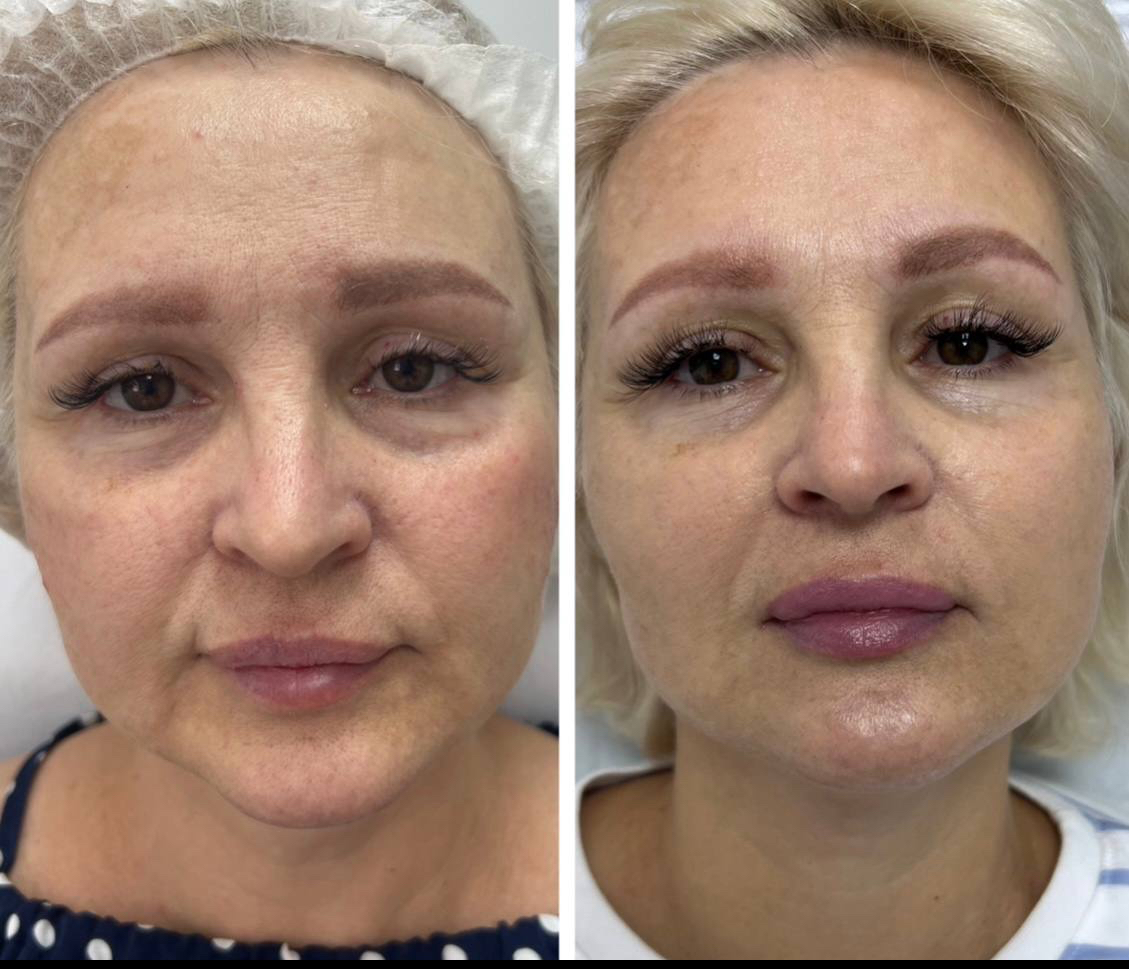 Výsledok procedúry RF-liftingu Morpheus 8 tváre a botulotoxínu hornej tretiny tváre