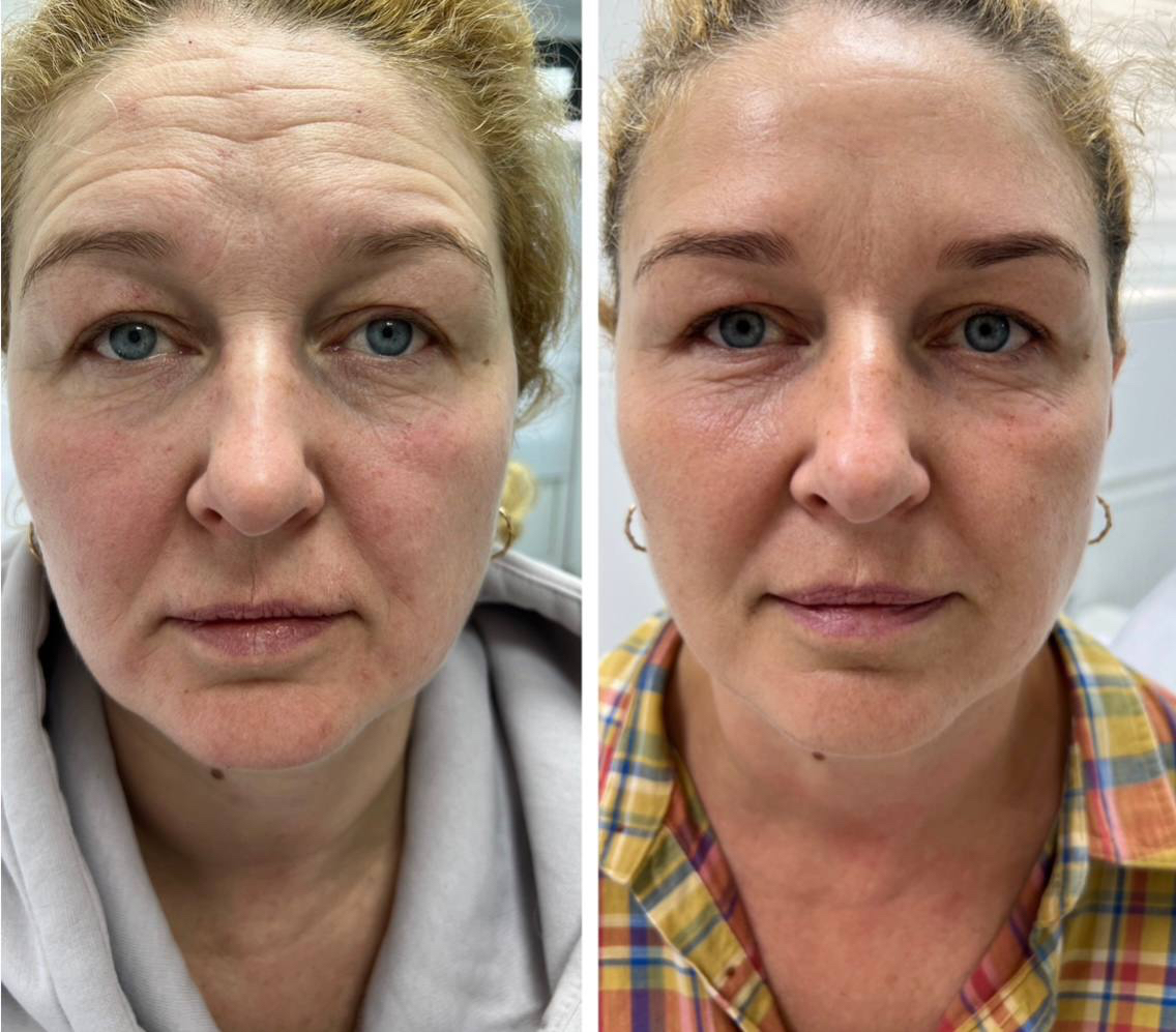 Výsledok procedúry RF-liftingu a botulotoxínu