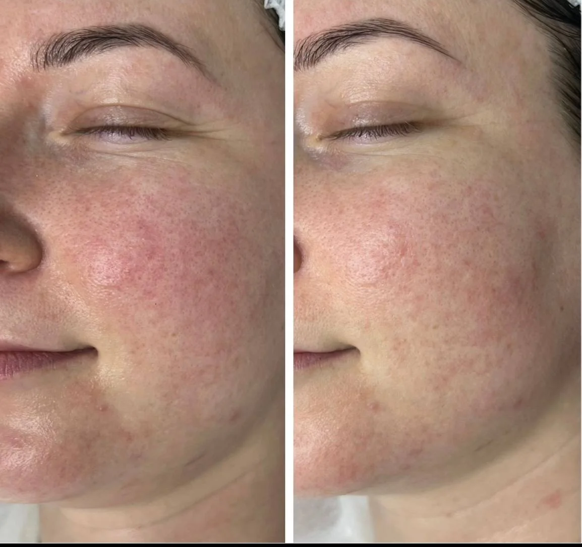 Mikroihličkový RF lifting jaziev, kožných defektov a strií