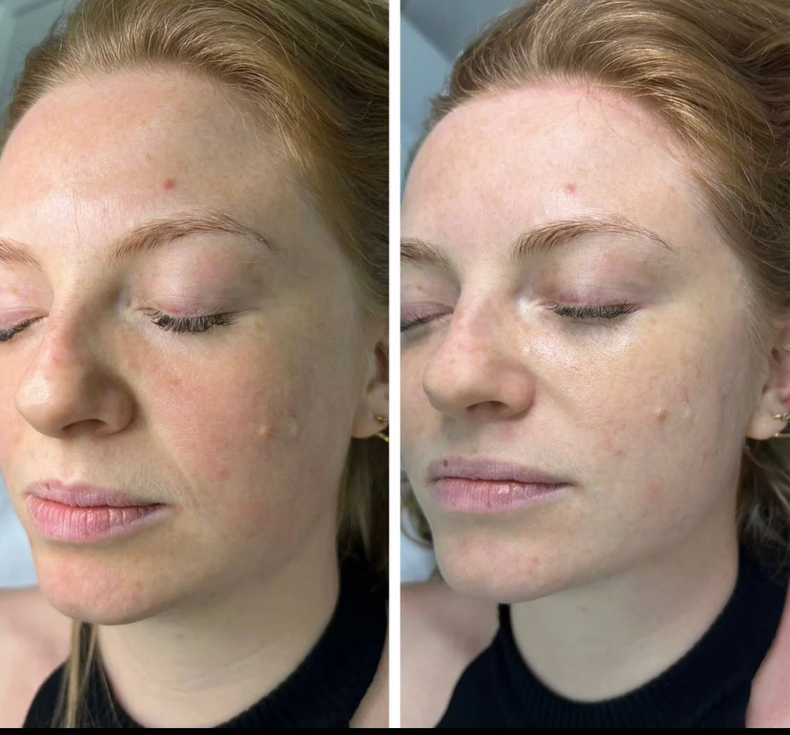 Mikroihličkový RF lifting jaziev, kožných defektov a strií — efekt procedúry