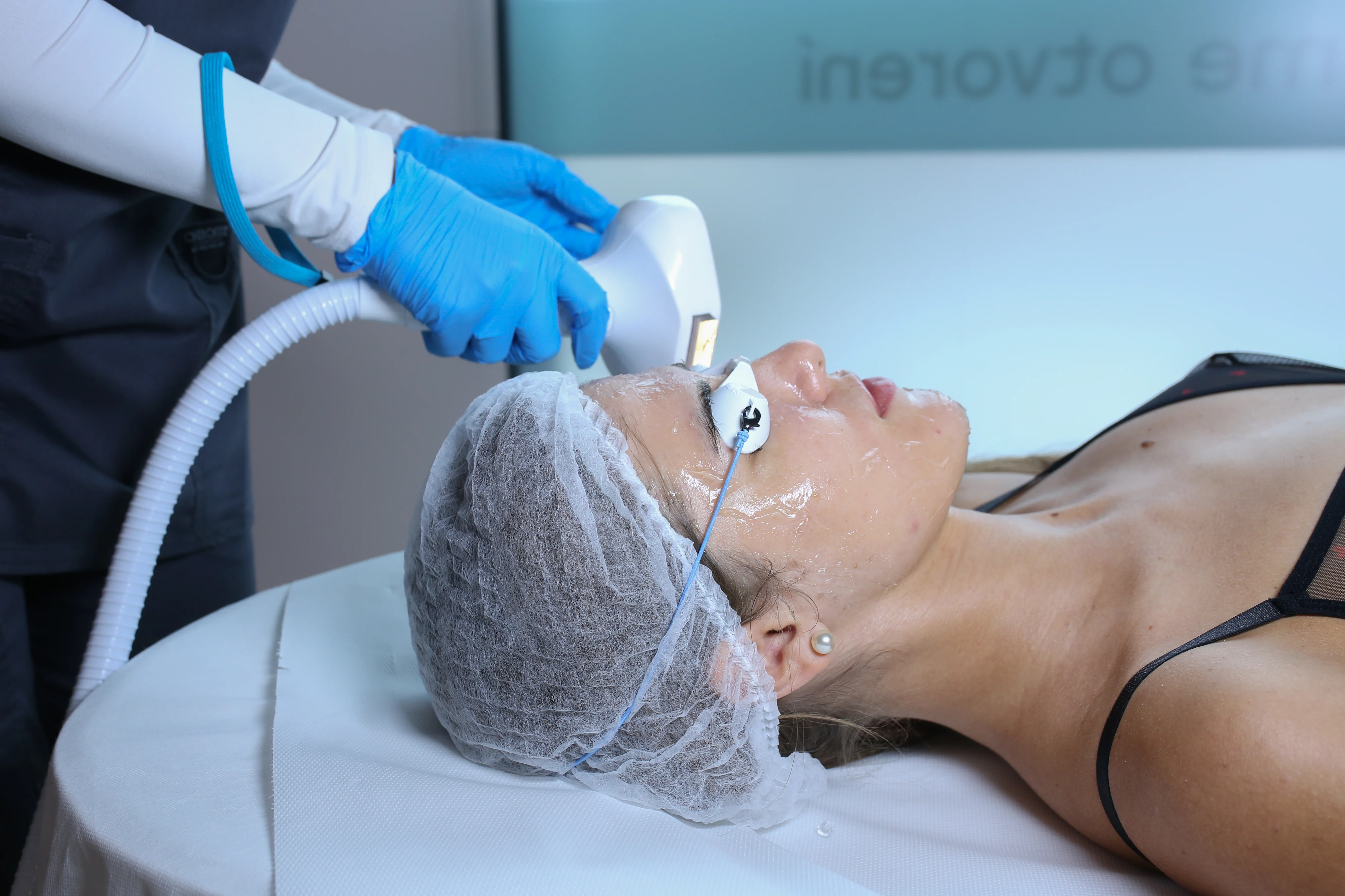 Fotorejuvenizácia (laserové omladenie) tváre IPL Lumecca