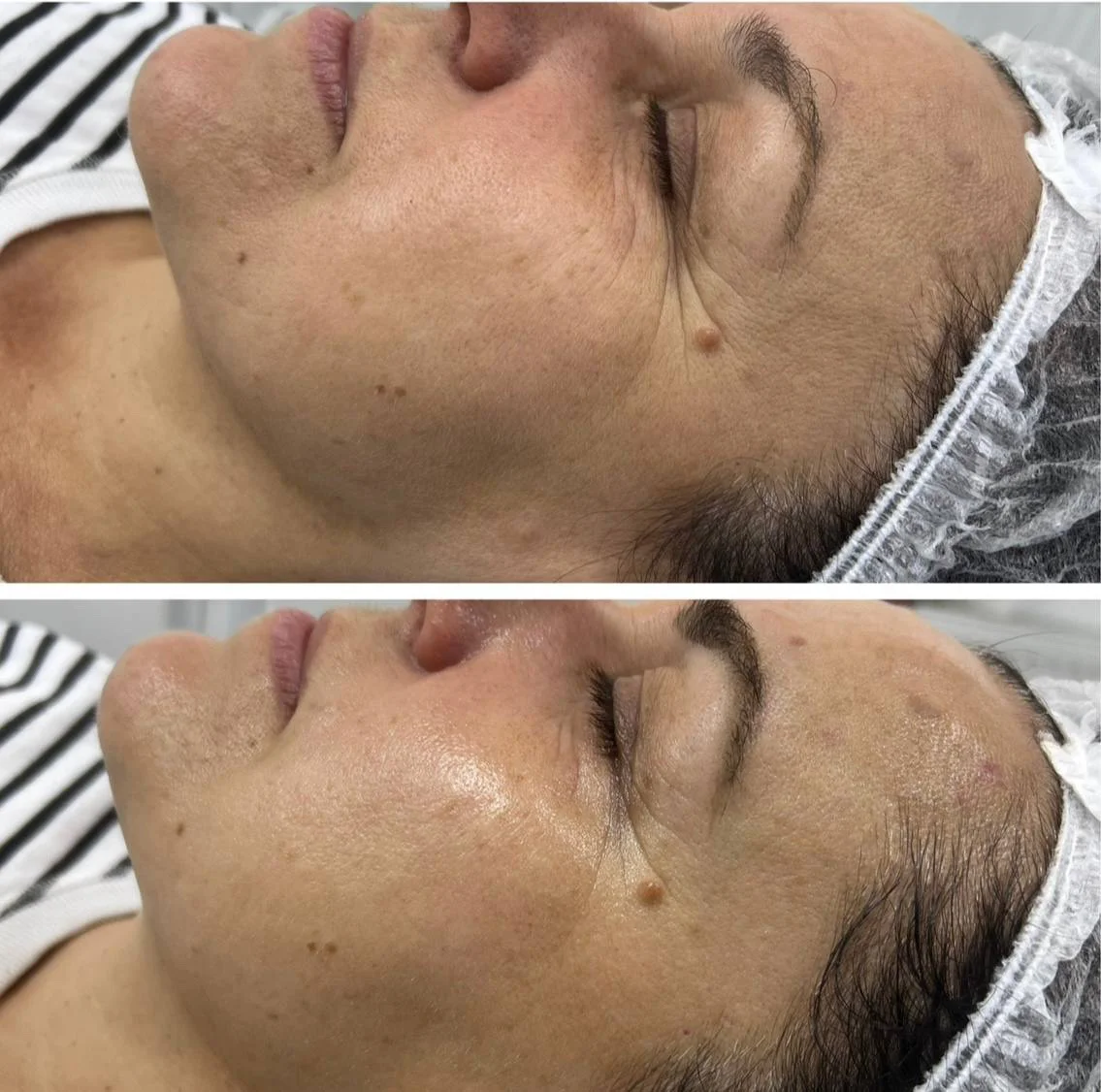 Plazmová sprcha (plazmový lifting, omladenie) — výsledok procedúry