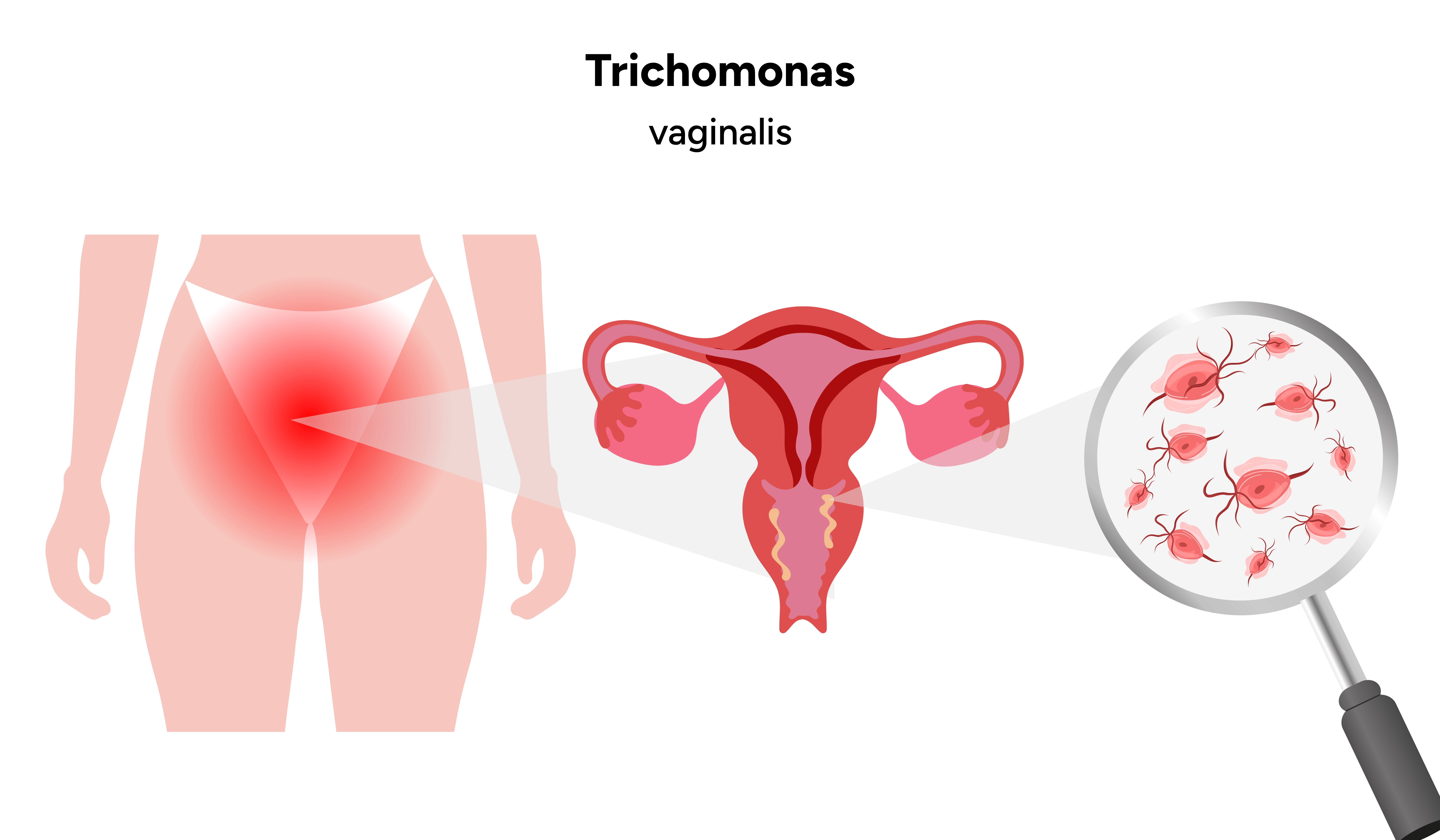 Trichomoniáza u žien