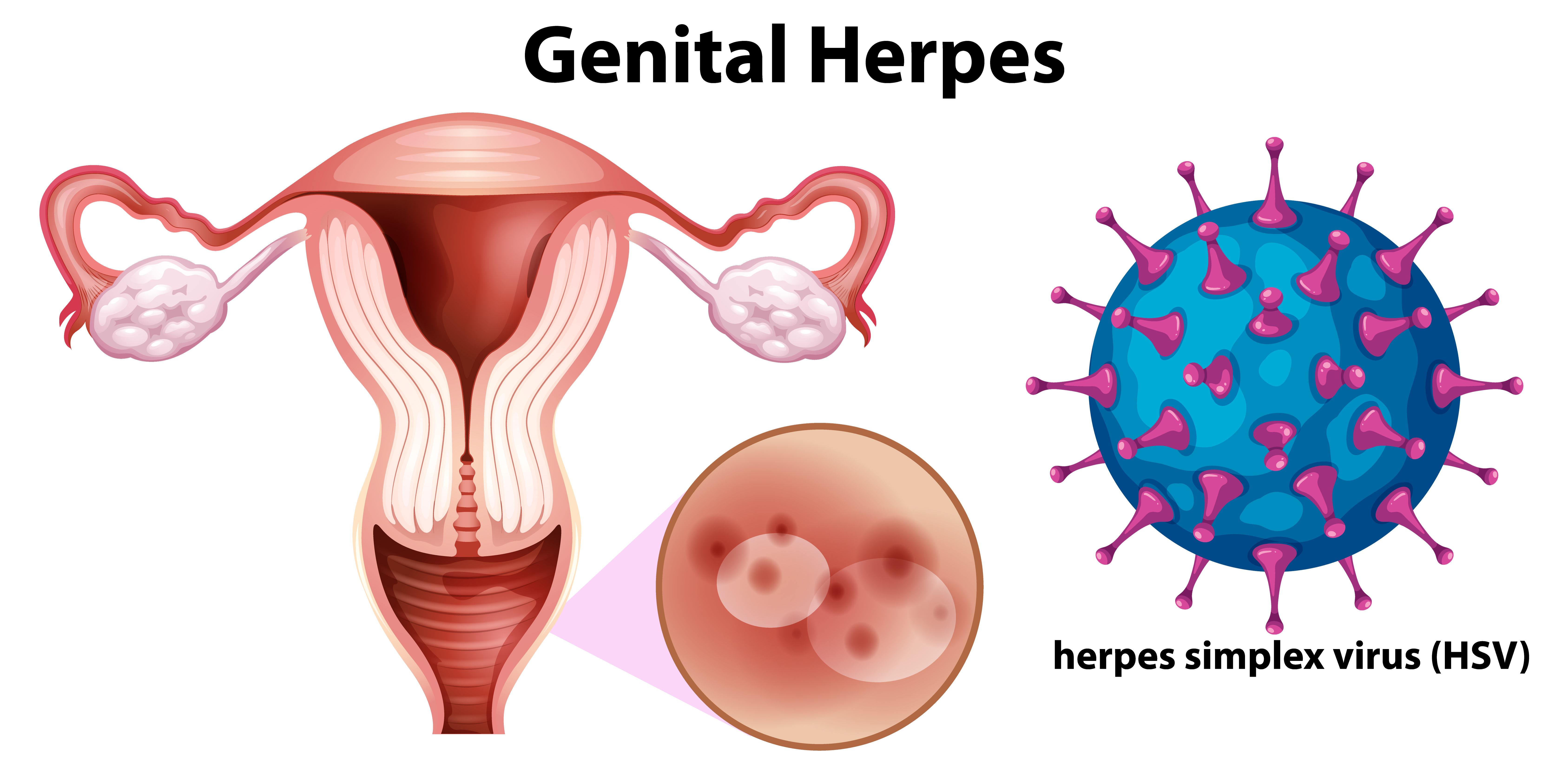 Čo je genitálny herpes?