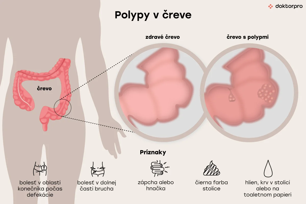Aké sú príznaky polypov v čreve?