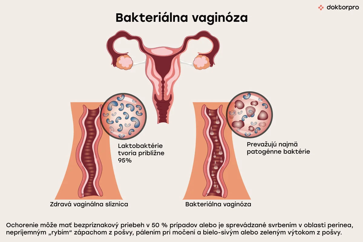 Bakteriálna vaginóza