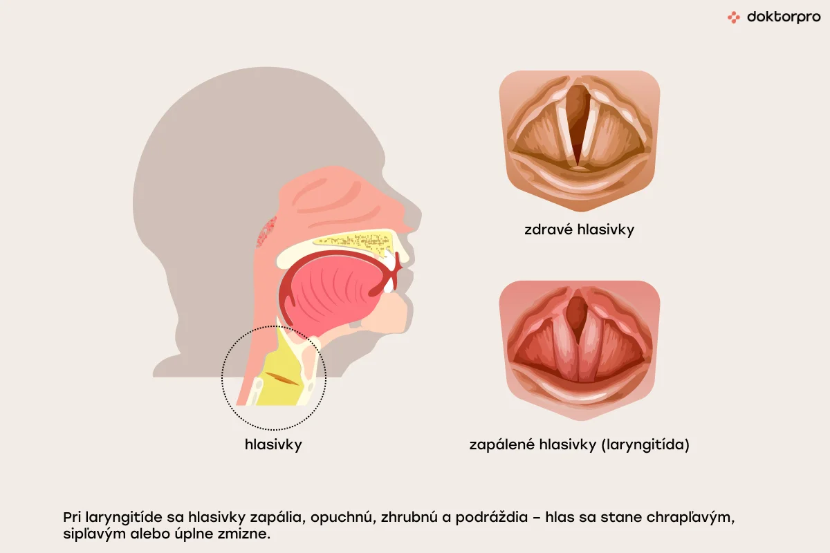 Laryngitída (zápal hrtana)