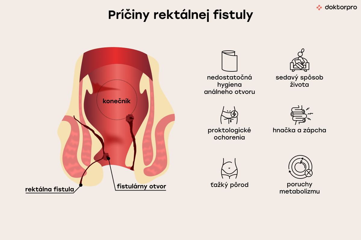Príčiny rektálnej fistuly