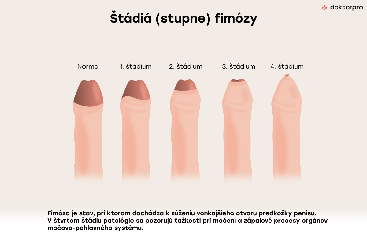 Štádia fimózy