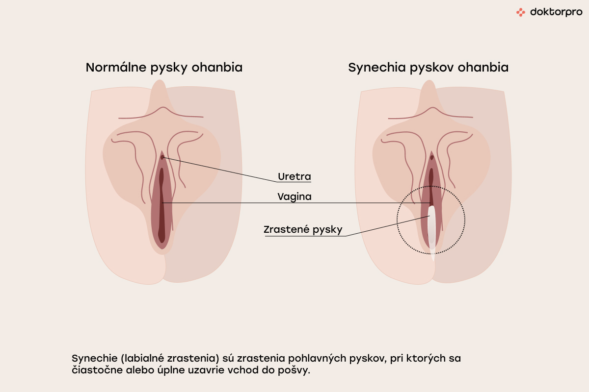 Ako vyzerá synechia vulvy?