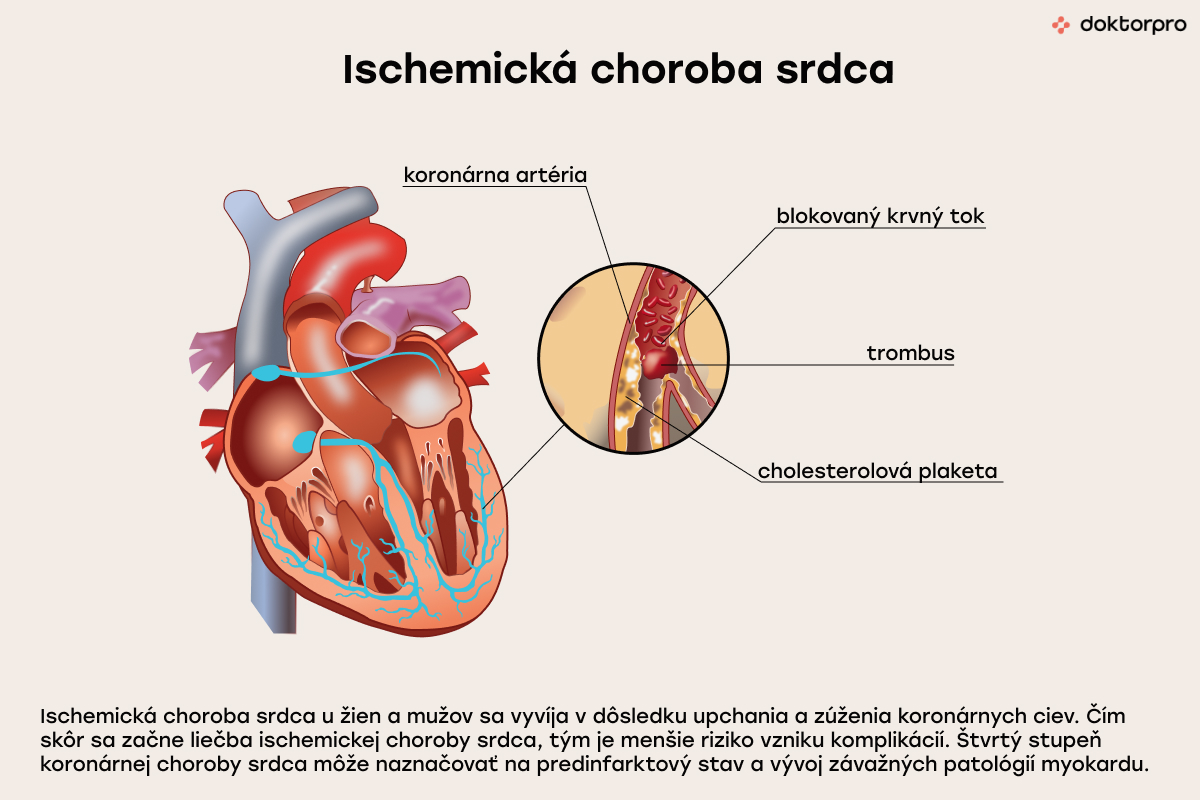 Ischemická choroba srdca