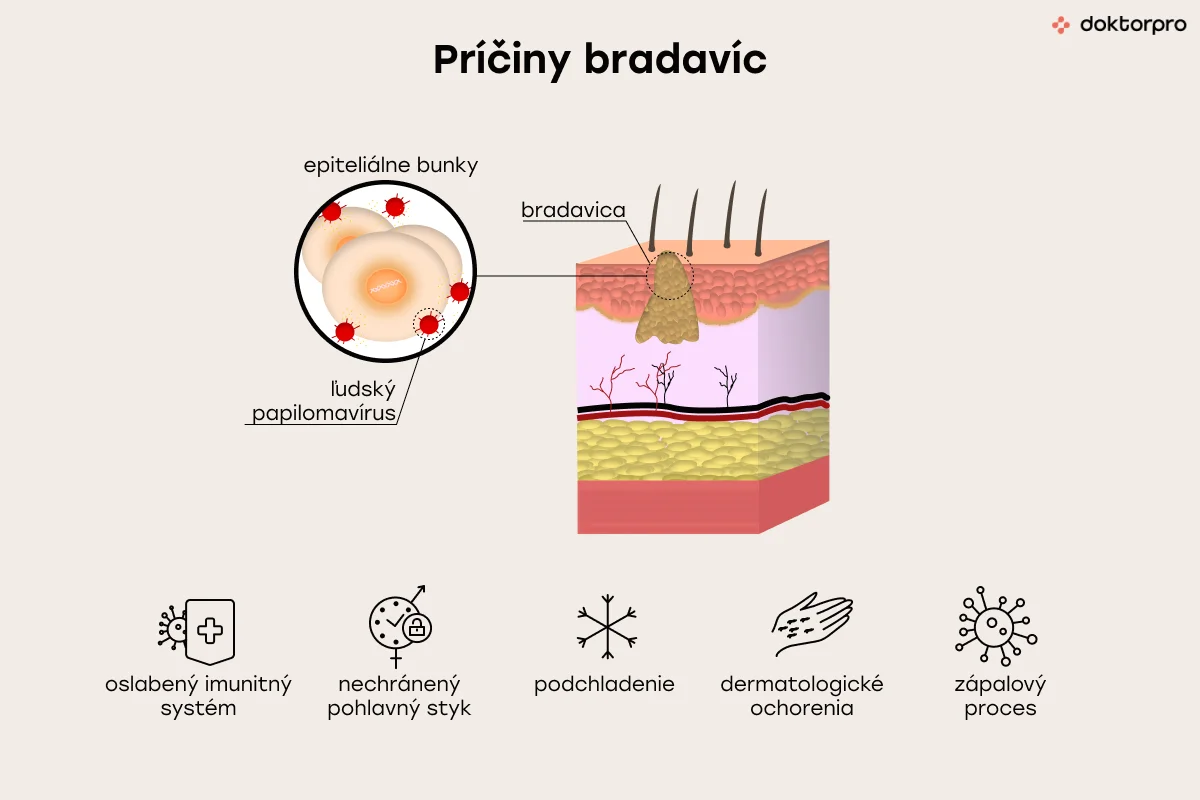 Príčiny bradavíc
