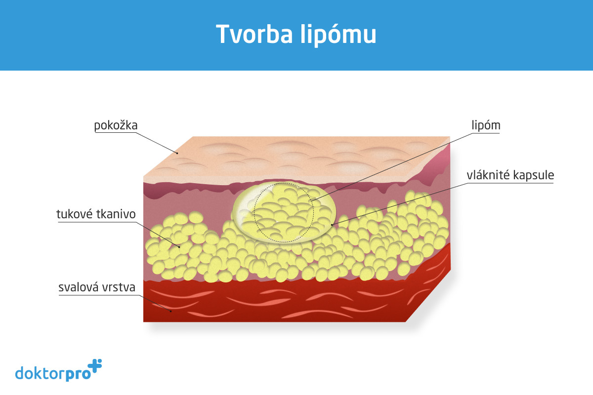 tvorba lipómu