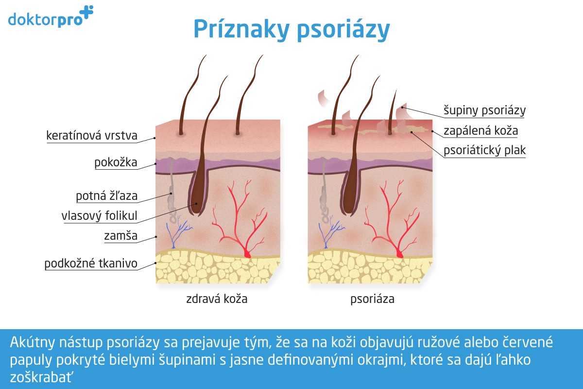 Príznaky psoriázy