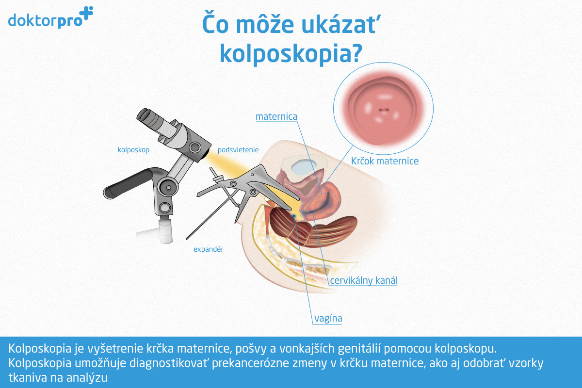 Čo môže ukázať kolposkopia?