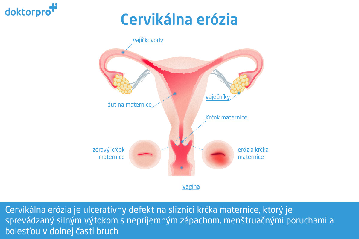 Cervikálna erózia