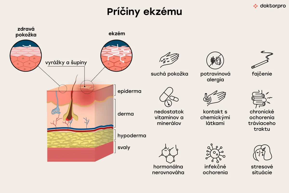 Príčiny ekzému