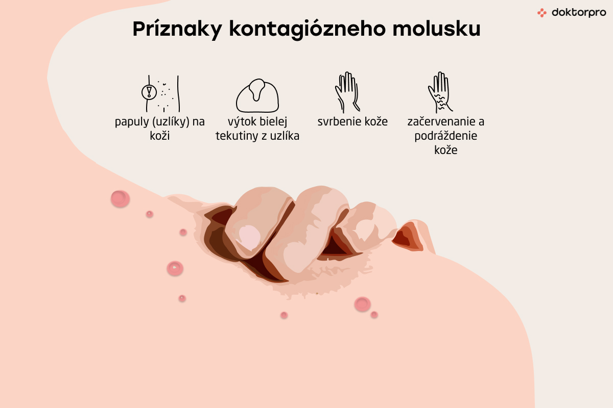 Príznaky kontagiózneho molusku