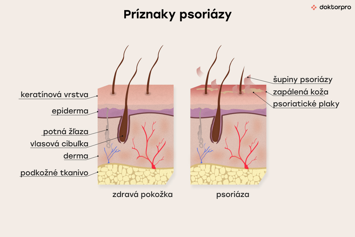 Príznaky psoriázy