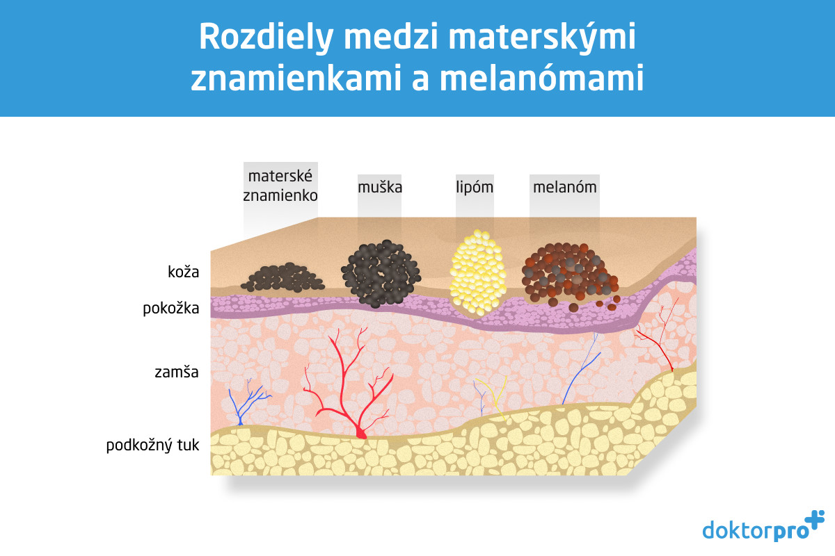 Rozdiely medzi materskými znamienkami a melanómami