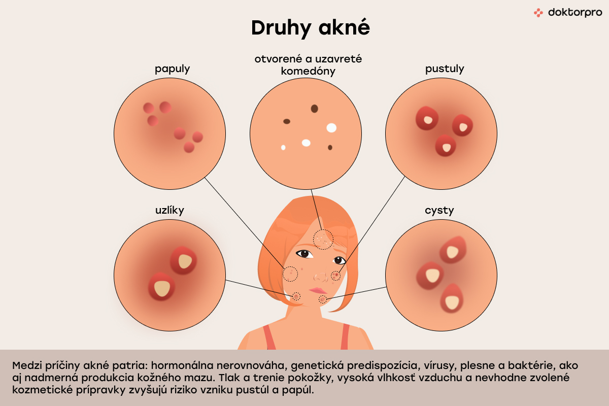 Druhy akné