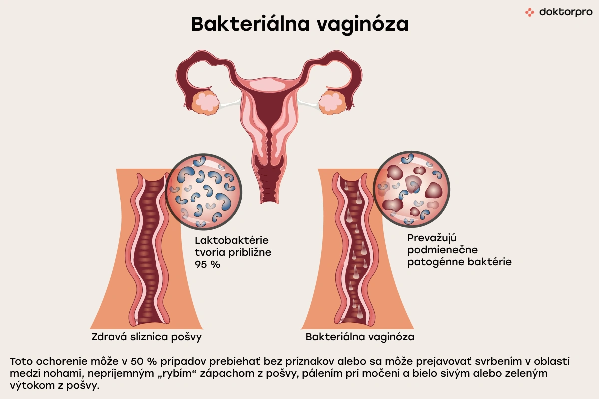 Bakteriálna vaginóza