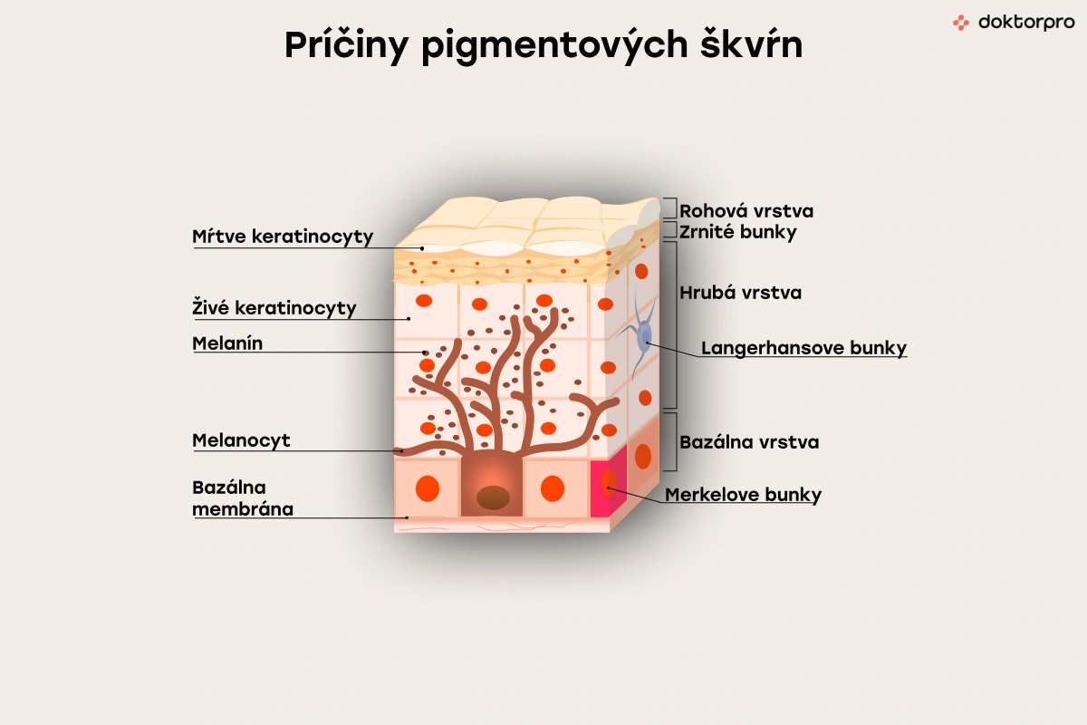 Príčiny pigmentových škvŕn