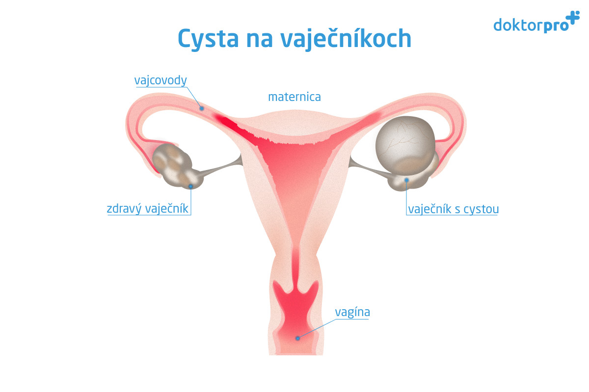 Cysta na vaječníkoch