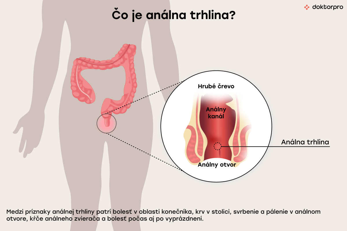 Čo je análna trhlina?