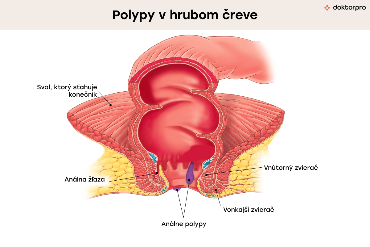 Polypy v hrubom čreve