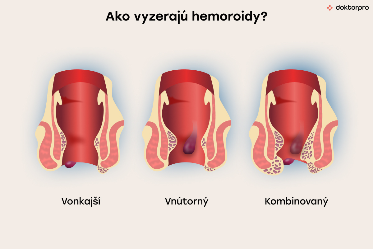 Ako vyzerajú hemoroidy?
