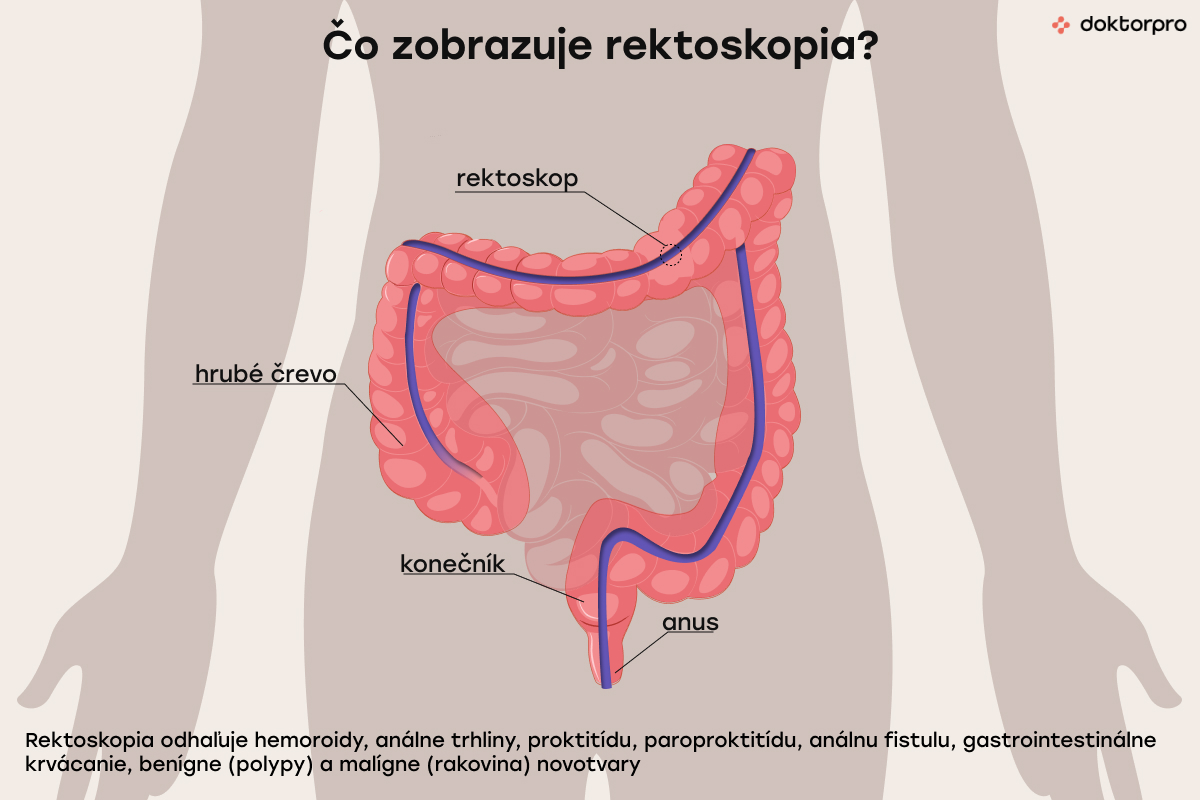 Čo zobrazuje rektoskopia?