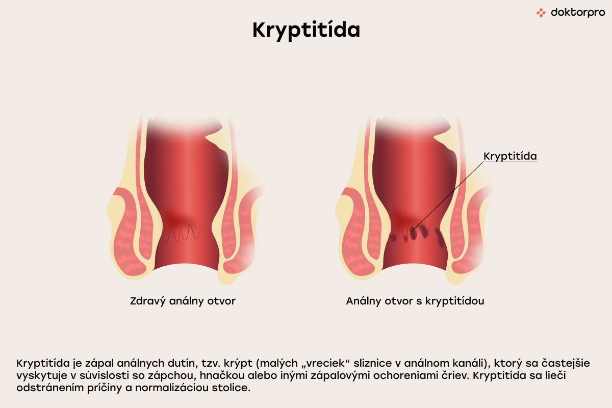 Čo je kryptitída?