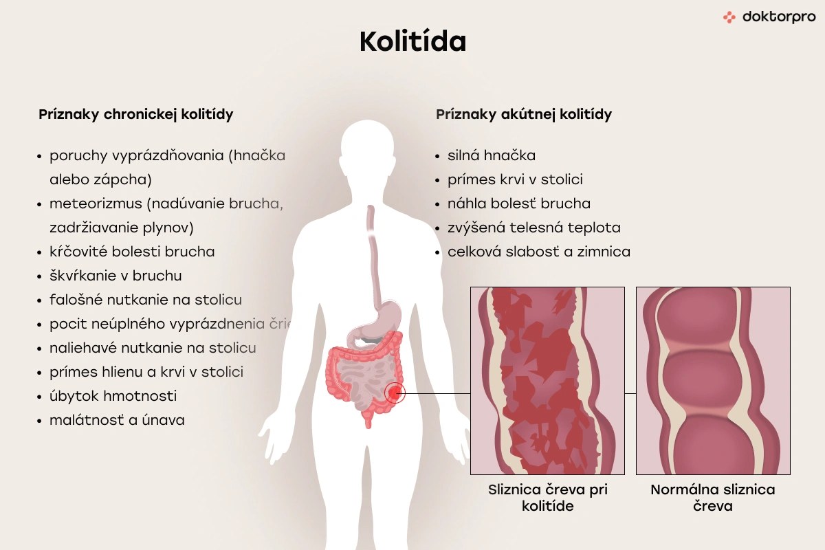 Čo je kolitída?