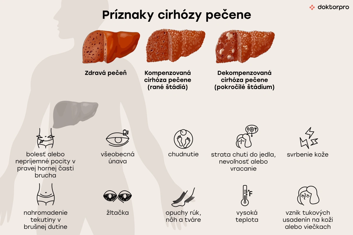 Príznaky cirhózy pečene