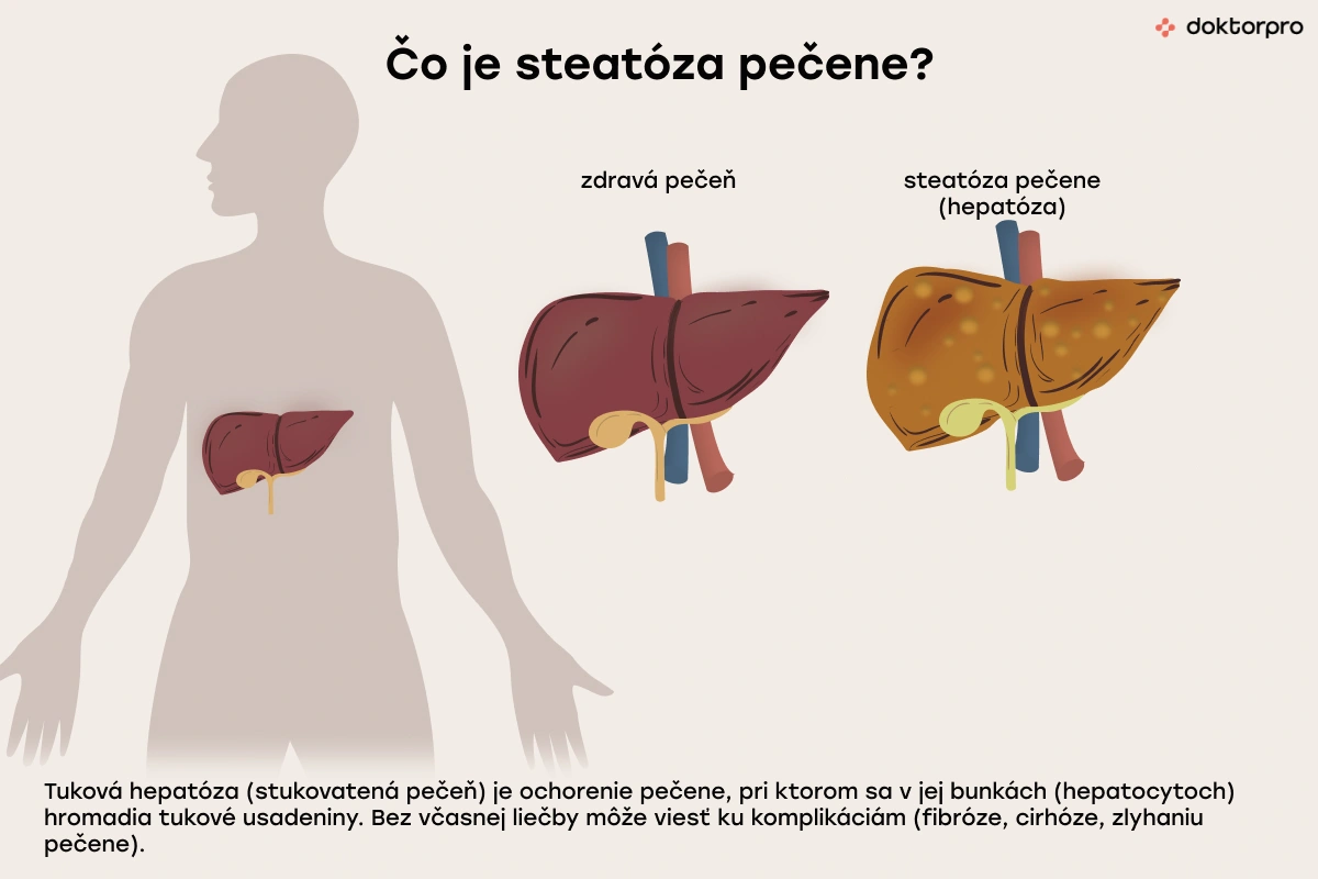 Čo je steatóza pečene?
