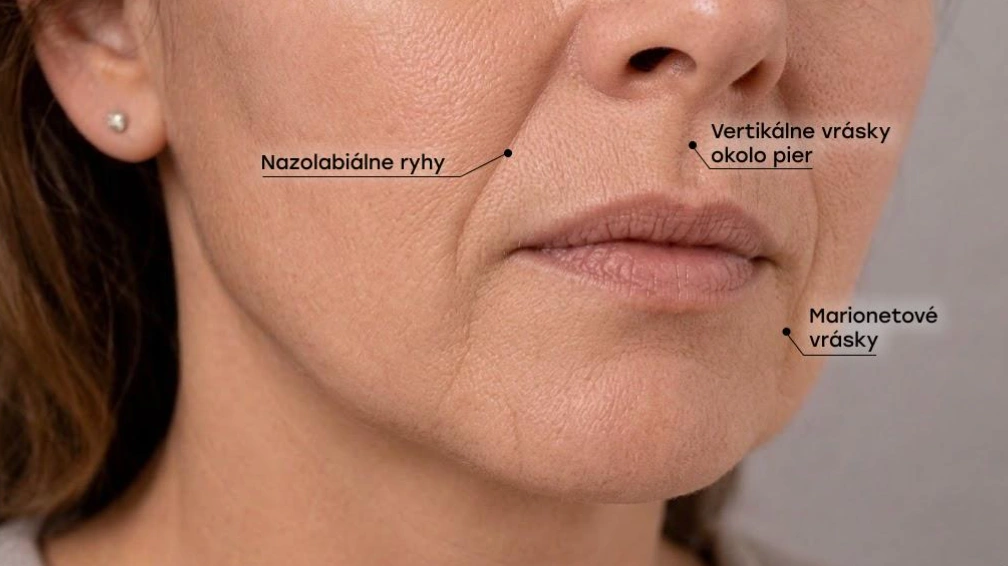 Tri typy periorálnych vrások: nazolabiálne ryhy, vertikálne vrásky okolo pier a marionetové vrásky.