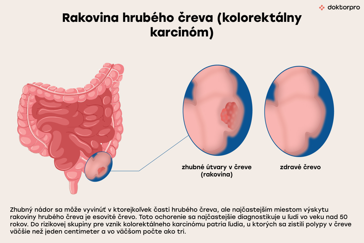 Rakovina hrubého čreva