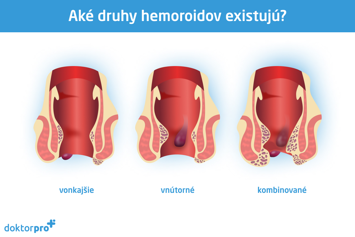 Aké druhy hemoroidov existujú?
