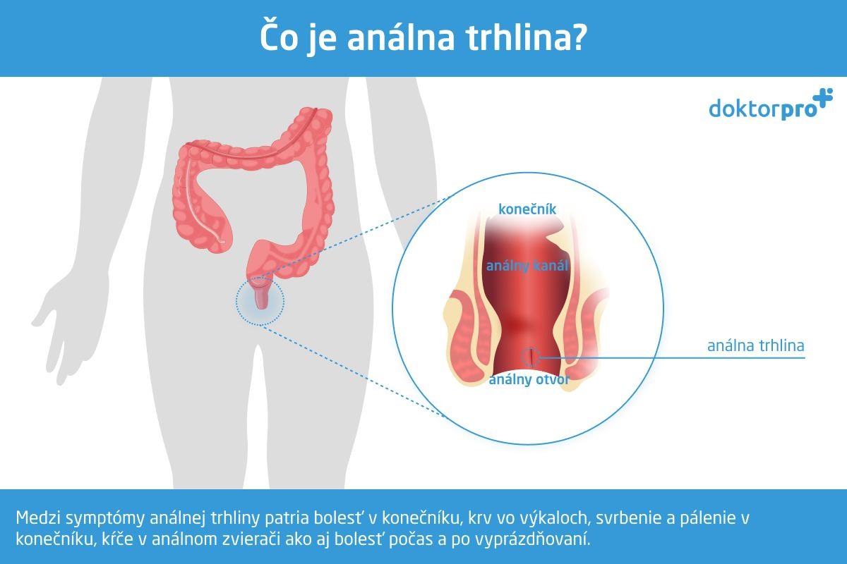 Čo je análna trhlina?