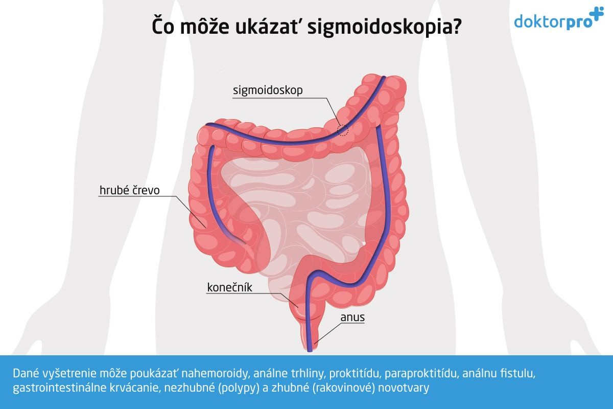 Čo môže ukázať sigmoidoskopia?