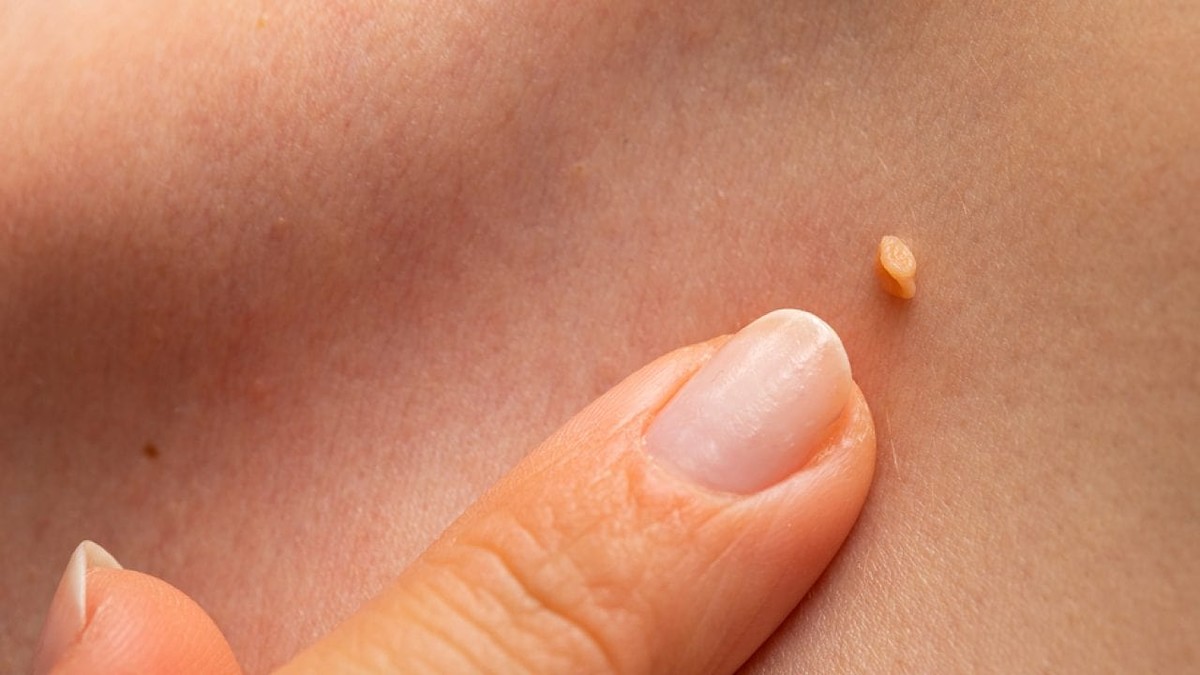 niťovité papilómy