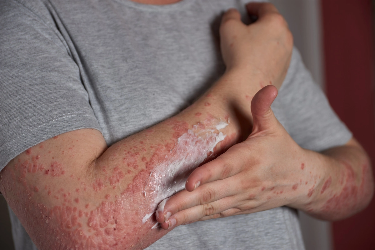 Čo spôsobuje psoriázu?