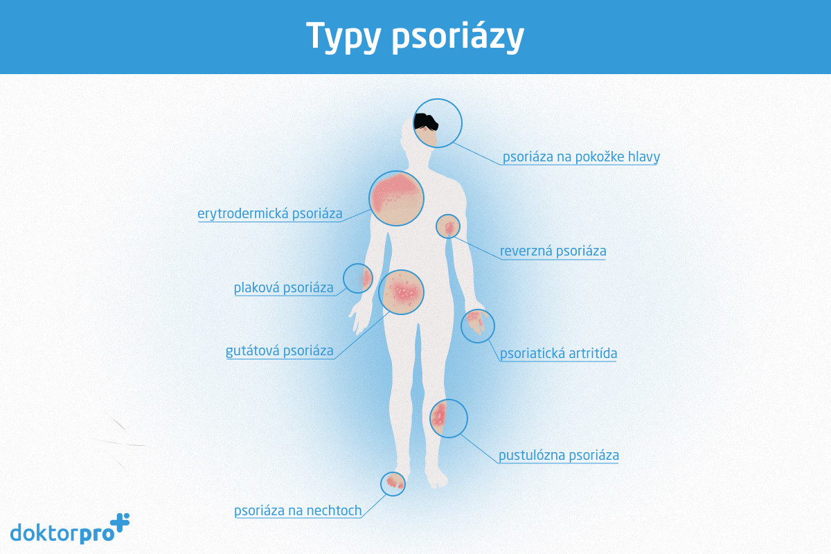 Typy psoriázy