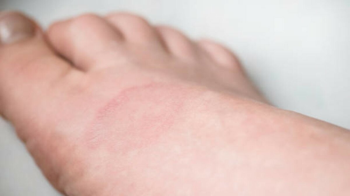 pityriasis rosea na nohe